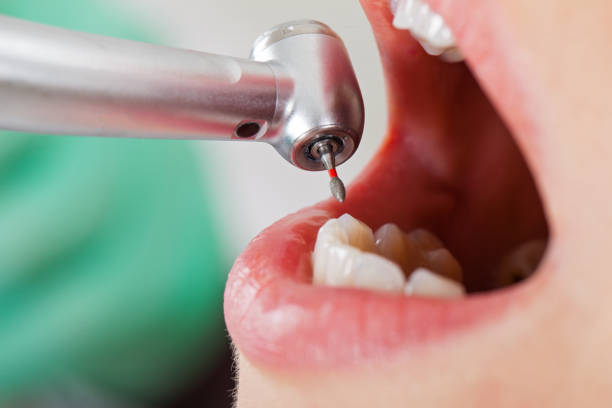 Best Emergency Tooth Extraction in Sardinia, OH